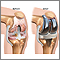 Knee joint replacement