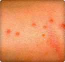 Bedbugs: Infestations, Bedbug Bites, and Getting Rid of Bedbugs