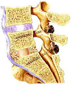 ACDF: A Useful Spinal Fusion Process