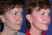 Facial Microcurrent: Do They Work Like a Facelift?