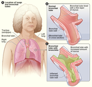 Bronchitis Symptoms, Causes, Prevention &Treatment