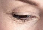 Get Rid of Under Eye Wrinkles - Causes, Best Treatments, Remedies, Creams, How to Prevent, Reduce, Remove Wrinkles