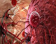 Low Cost Cancer Treatment in India