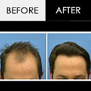 Hair Transplant in Indore | Hair Loss Treatment Specialist Doctors – Marmm.