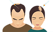 Best Hair Loss Treatment Is PRP