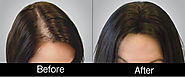 PRP Hair Loss Treatment Effect On Hair Loss