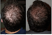 Is PRP Hair Loss Treatment Good For Hair Loss & Hair Thinning Problem?