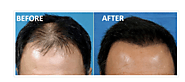 How To Stop Hair Thinning Problem By PRP Hair Loss Treatment In Both The Men & Women. – marmmclinic
