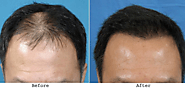Feel Hopeless And Depressed? Trust And Use PRP Hair Loss Treatment For Hair Loss! – marmmclinic