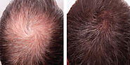 From Thinning Of Hair to Thick and Dense Hair – marmmclinic