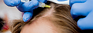 الميزوثيرابي : العلاج الغير جراحي لإستعادة الشعر الطبيعي | عيادة زراعة الشعر في دبي الامارات