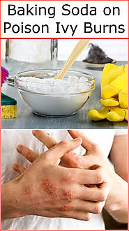 Baking Soda on Poison Ivy Burns | Baking Soda Uses and DIY Home Remedies.