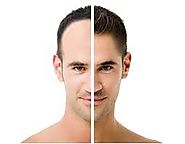 Effective way to tackle hair loss-Hair Transplant Surgery