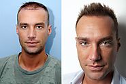 How do hair transplants work and which celebrities have had the procedure?