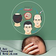 What You Need To Know Before Having Hair Transplant Surgery?