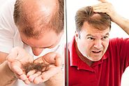 What is male pattern baldness, is it inherited from your parents and what are the early signs?