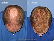 Hair Loss and Treatments To Cure Hair Loss
