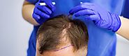 Hair Transplant Growth Stages! READ THIS