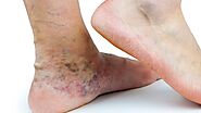Blue, Discolored Feet: What You Should Know | USA Vascular