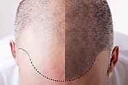 Causes and Treatment for Male Pattern Baldness – hair loss treatment