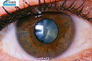 Best Cataract Eye Treatment in Chennai – Drr eye hospital – Medium