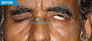 Facial Paralysis Surgery Specialist center or Hospital in chennai -DRR