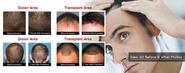 Hair Transplant & Hair Restoration Surgery By Best Surgeon in Boca Raton, Florida- Charles Medical Group