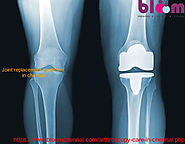 Joint replacement treatment in chennai