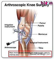 Arthroscopy Service in Chennai