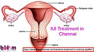 IUI Treatment in Chennai