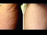 micro derma needle roller before after - Google Search