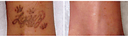 Tattoo Removal at London based Courthouse Clinics