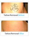 Tattoo Removal London UK Results in Record Time