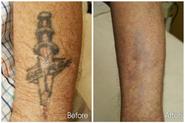 Does laser tattoo removal really work?