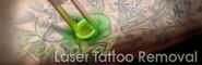 Laser Tattoo Removal " Precision Laser Studio