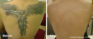 Tattoo Removal And Laser Tattoo Removal | Removing Tattoos Across The UK |