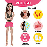 Vitiligo