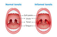 Tonsillitis