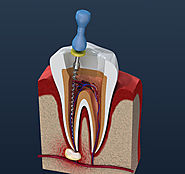 Website at https://www.bluetoothdentalclinic.co.in/root-canal-treatment