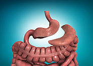 عملية تكميم المعدة | دكتور وائل شعلان