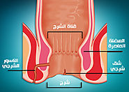 جراحات الشرج المختلفة | دكتور وائل شعلان