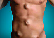 جراحات الفتق المختلفة | دكتور وائل شعلان