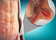 علاج الفتق الأربي | دكتور وائل شعلان