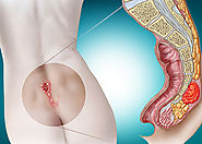 علاج الناسور العصعصي | دكتور وائل شعلان