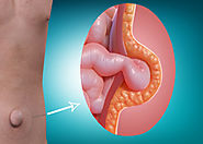 علاج الفتق السري | دكتور وائل شعلان