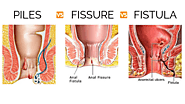 What are piles and fissure, its symptoms and cure?