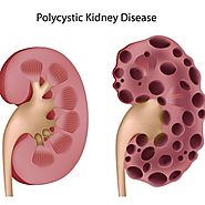 Treatment Options on Polycystic Kidney Disease 2016