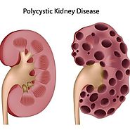 Top Treatment Options on Polycystic Kidney Disease 2016