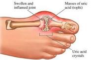 Natural Treatment and Home Remedy for Gout Reviews 2016