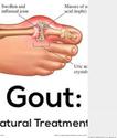 Gout Treatment Natural Remedies, Relief and Medicine Reviews 2016
